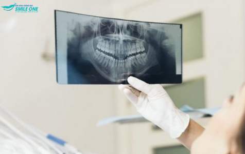 Tại sao phải chụp phim X-quang trước khi niềng răng?